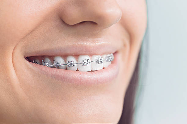 Best Traditional Braces  in Clark Mills, NY